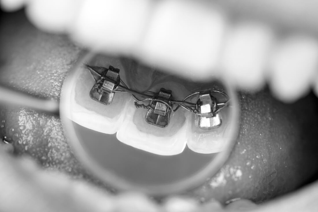 Kieferorthopaedie-St-Sebastian-Krennerich-Lingual-Technik Kieferorthopaedie-St-Sebastian-Krennerich-Lingual-Technik